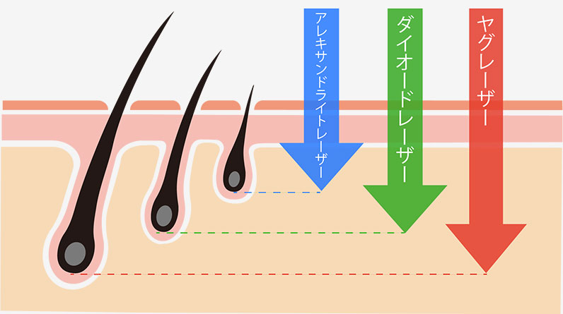 なぜ3つの脱毛器が必要か？